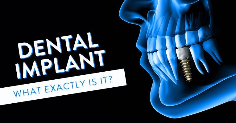 what is a dental implant