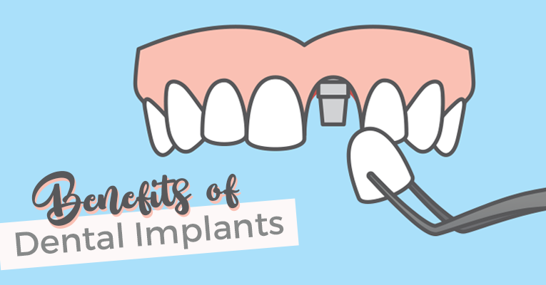 Dental Implant Benefits 