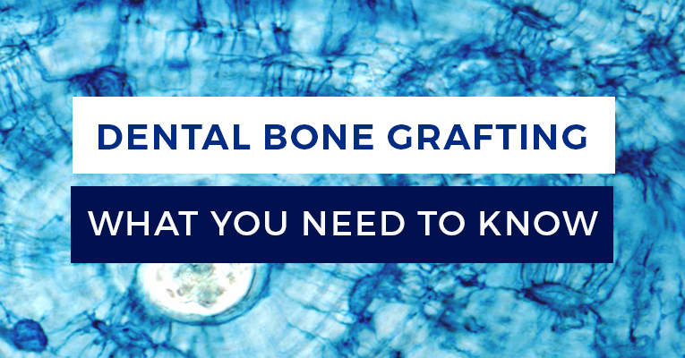 Bone Grafts